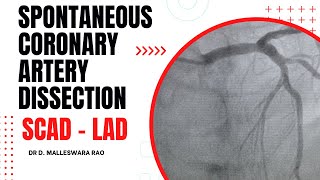 Spontaneous coronary artery dissection (SCAD) - LAD