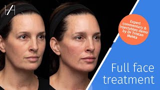 Face Dermal Fillers Treatment Demonstration by Dr Tristan Mehta