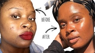 How to Clear Acne + Acne Scars | Jasmine Mitchell