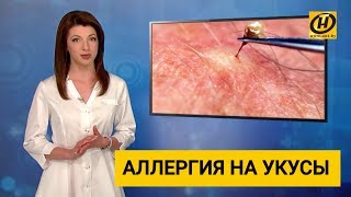 Аллергия на укусы ос, пчёл и других насекомых. Инсектная аллергия.