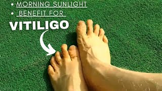 Morning Sunlight Good for Vitiligo | Sun Therapy for White Patches