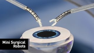 Axsis, a Minimally Invasive Robot, Performs Cataract Surgery