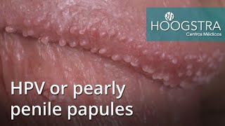 HPV or pearly penile papules (20165)