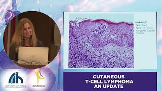 DIAGNOSIS, STAGING AND MANAGEMENTOF CUTANEOUS T-CELL LYMPHOMA (CTCL) - PROF. JULIA SCARISBRICK