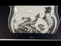 ct scan of a calcified adrenal mass with dr. tobias carling