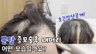 분당매듭 증모술후 내머리는 어떤 모습일까요.