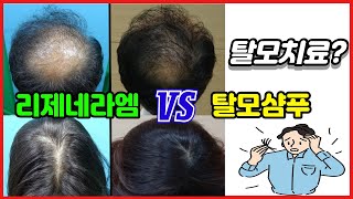 탈모치료? 리제네라엠 VS 탈모샴푸 #강남삼성성형외과