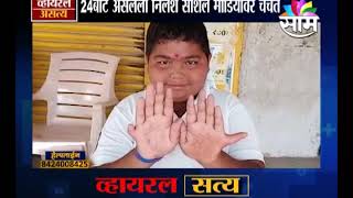 #ViralSatya :: तुम्ही कधी 24 बोटं असलेला चिमुरडा पाहिला आहेत का ?