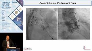 M. Kasel  | To crack or not to crack? The role for fracturing bioprosthetic valves during     ViV...