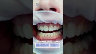 Циркониевые коронки выглядят как свои зубы. Zirconium crowns look like their teeth.