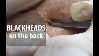 Back Blackhead Removal | Dr. Derm