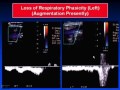 Ultrasound of Vascular Emergencies