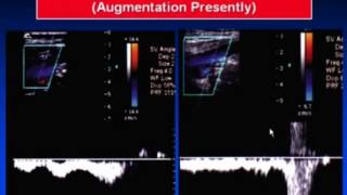 Ultrasound of Vascular Emergencies