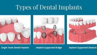 డెంటల్ ఇంప్లాంట్ || Dental implant