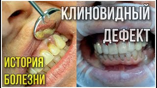 Клиновидные дефекты зубов.