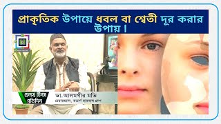 ধবল কেন হয়? | How To Get Rid Of Skin White Disease Naturally | Modern Health Bd