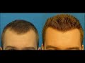 Difference Between FUE Hair Transplant Method And FUT Method - What Are The Risks Associated