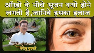 आँखों के नीचे सूजन क्यों हो जाती है ,जानिए इसका घरेलू इलाज | HOME REMEDY FOR EYE BAGS \u0026 PUFFINESS