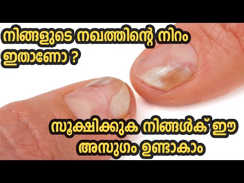 നിങ്ങളുടെ നഖത്തിന്റെ നിറം ഇതാണോ? സൂക്ഷിക്കുക നിങ്ങൾക് ഈ അസുഗം ഉണ്ടാകാം Nails Say About Your Health നിങ്ങളുടെ നഖത്തിന്റെ നിറം ഇതാണോ? സൂക്ഷിക്കുക നിങ്ങൾക് ഈ അസുഗം ഉണ്ടാകാം Nails Say About Your Health