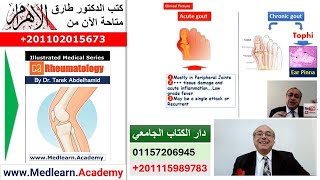 Gout (Gouty arthritis) #cme #internal_medicine  #usmle #medicalschool   #medical #محاضرات_باطنة