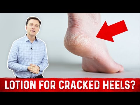 Why Lotion Never Fixes Dry Cracked Feet & Heels Why Lotion Never Fixes Dry Cracked Feet & Heels
