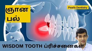 3rd Molar | ஞான பல் விஸ்டம் டூத் தரும் பிரச்சனைகள் | Dr Arunkumar | Pearls Dentistry | Chennai