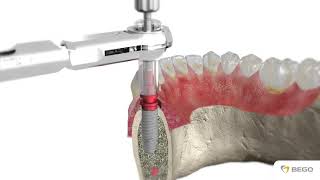 BEGO Semados® RS/RSXPro Implantate / RS RSX Pro Implants