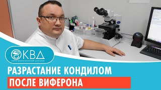 💣 Разрастание кондилом после виферона. Клинический случай №851