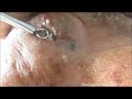 Cleaning Ala Of Nose   Blackheads