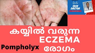 കയ്യിൽ വരുന്ന eczema രോഗം /pompholyx hand eczema /dr sujith kumar Dermatologist