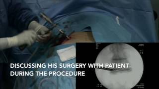 Foraminal Stenosis treated with Transforaminal Endoscopic Decompression