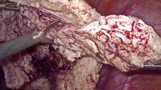 Adenomyomectomy  With Flap Repair #surgerytips