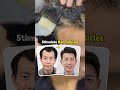 8 Months Miracle with Jonsson Protein Hair Growth Treatment