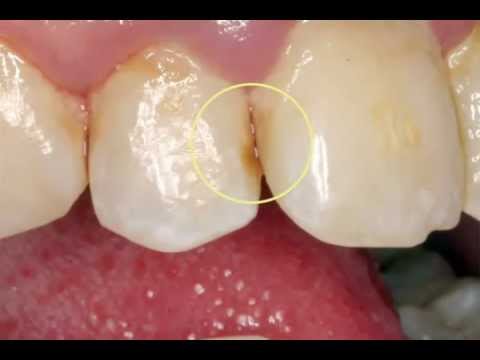 Tooth Decay - How to Avoid It Tooth Decay - How to Avoid It