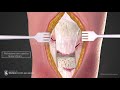 Patella Tendon Repair