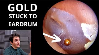 Gold Orb Stuck To Eardrum