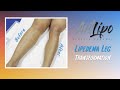 Lipedema Legs | Cankles & Knees Liposuction | Expert Dr. Thomas Su