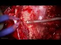 suboccipital craniotomy for resection of a vermian glioneuronal tumor