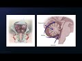 suboccipital craniotomy for resection of a vermian glioneuronal tumor