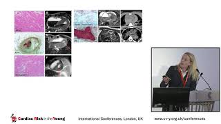 CRY Conference 2018 - Molecular Autopsy after a Sudden Cardiac Death - Dr Belinda Gray
