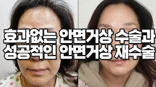 효과없는 안면거상 수술과 성공적인 안면거상 재수술의 차이