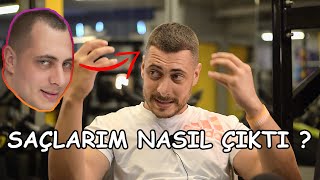 Saçlarım nasıl tekrardan çıktı Saç Dökülmesi İçin Önlemini Al !