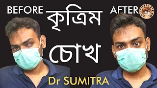 কৃত্রিম চোখ প্রতিস্থাপন | Artificial eye | Dr Sumitra | পাথরের চোখ | নকল চোখ | কাঁচের চোখ