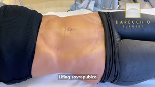 Lifting Ultrabasso | Pelle In Eccesso | Diastasi Addominale | Dr. Darecchio