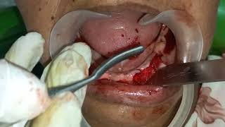 Alveoloplasty and Alveolectomy of edentulous jaws