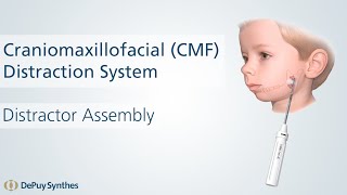 DePuy Synthes Craniomaxillofacial (CMF) Distraction System- Assembly Animation