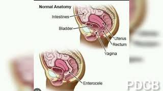 MRI Defecography @ MR Defecography কিভাবে করে