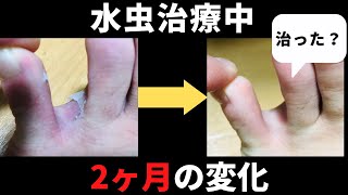 【閲覧注意】30代男、ただいま水虫治療中。2か月目の変化！え、治った？【水虫スライドショー】