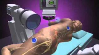 NuVasive XLIF - Minimally Invasive Spine Surgery - Dr. Bashir