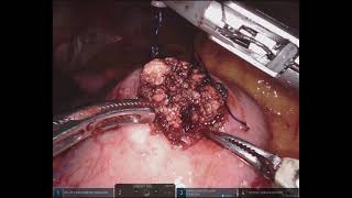 Robotic Pancreatogastric anastomosis with external pancreatic duct drainage